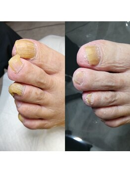 【肥厚・変形爪】ネイル/フット
