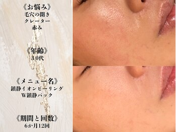 アクール(Accueil)/【毛穴】