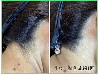 クリア 尾張旭店(Clear)/【Clear脱毛ビフォーアフター】