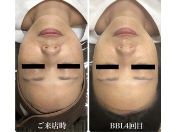 ホッコリ 府中店(HOKKORI)/BBLフェイシャル～透明感up