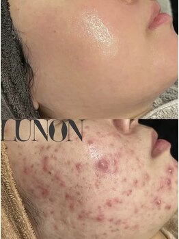 ルノン 天神店(LUNON)/ニキビ改善《症例》