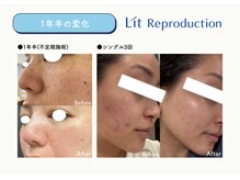 アニュー(anew.)/【Lit症例】フェイシャル