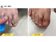 ふっとけ庵/肥厚爪ケア