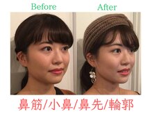 ラプリ 福岡天神店(Raplit)/隆鼻+輪郭・小顔矯正 美鼻/小顔