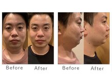 マリーローランメンズグレース(Marryrolan MensGrace)/リベルハーブピーリング症例