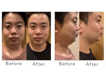 マリーローランメンズグレース(Marryrolan MensGrace)/リベルハーブピーリング症例