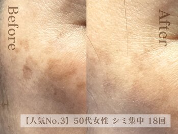 ディレイア ザ コスメ 有楽町マルイ店(direia the cosme)/シミ/くすみ/月1～2回［有楽町］