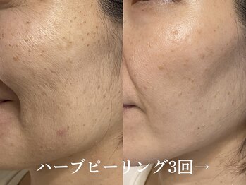 シュリー(Sriii)の写真/年齢肌ケアに◎【シミ改善・毛穴レス・リフトUP】古い角質リセット！スベスベ美肌になる♪ハーブピーリング