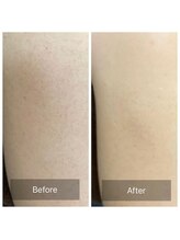 アーユルヴェーダアンドアロマエステ アユス(AYUS)/ハーブピーリング　背中