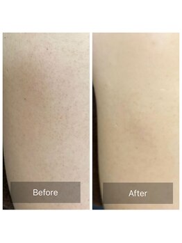 アーユルヴェーダアンドアロマエステ アユス(AYUS)/ハーブピーリング 背中