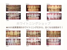 ホワイトニングショップ 久留米店(WHITENING SHOP)/お客様のビフォーアフターです！