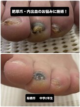 巻き爪じゅん 千葉駅前店/【注目】肥厚爪と変色が改善！