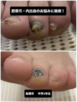 巻き爪じゅん 千葉駅前店/【注目】肥厚爪と変色が改善！