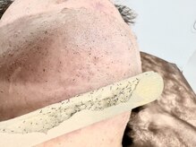 ランプ(LAMP)/～ハイブリッドヒゲ脱毛～