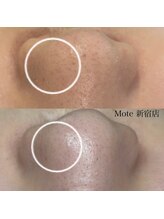 モテ 新宿店(Mote)/ハイドラ毛穴洗浄＋艶肌Wax 新宿