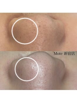 モテ 新宿店(Mote)/ハイドラ毛穴洗浄+艶肌Wax 新宿