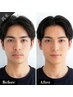 【ひげ脱毛】メンシプ用/メンズ特化×痛み少ない♪濃い青ひげバイバイ