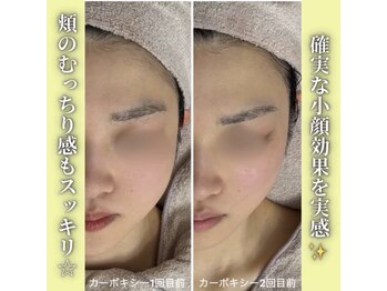 ハニエル(Haniel)/カーボキシー症例