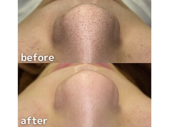 サージュクロレ 松戸店(sage colorer)/圧倒的人気★毛穴クリーンケア