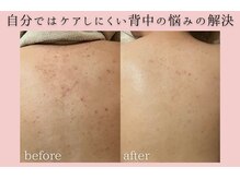 フォーウーマン(for woman)/背中ピーリング＋セルサー 