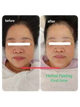 エム(M)/ハーブピーリング