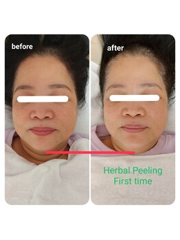 エム(M)/ハーブピーリング