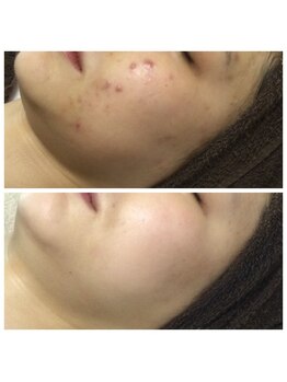 リラーナ(Re rana)/大人ニキビケア♪