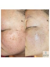 ポルテ(porte)/60代　光沢フォト9回+ハーブ5回