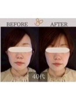 チョコバリ 錦糸町店(chocobari)/小顔×リフトアップ(美容鍼)40代