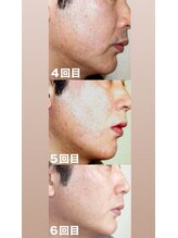 ビューティーサロンレモン(Lemon)/髭脱毛4～6回目