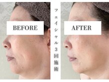 リアレント 高槻店(Lialent)/気になるシワにもアプローチ♪