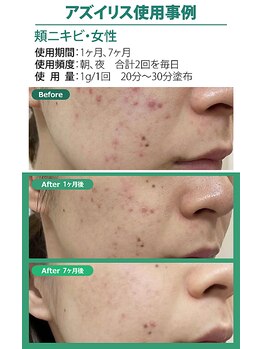 ベイジョ デ アンジョ(Beijo de anjo)/アズイリス