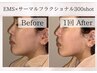 【目/たるみ/リフトアップ/毛穴縮小】EMS×サーマルフラクショナル300shot☆