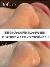 【 ハーブピーリング/ニキビ/毛穴/シミ/シワ 】ar.ハーブピーリング専門店&nbsp;お肌状態で 施術提案◎