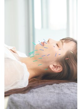 トライム(Trime)/美容鍼