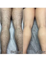 アルゴ 春日那珂川店(ALGO)/人気の足脱毛★