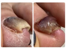 ロンディネ(Rondine)/巻き爪&トラブルネイルケア13