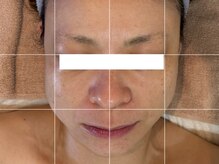 バイ リス(by LYS.)/フェイスラインにアプローチ