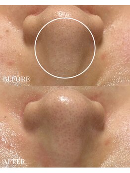 エース(ACE.)/浮き出した汚れごっそり!