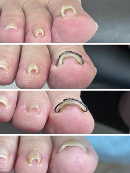 巻き爪矯正センター 沖縄 宜野湾/巻き爪矯正　