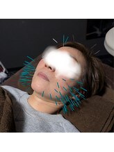 あいこ鍼灸院/天使の100本美容鍼