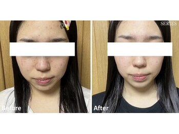 フーラ バイ アングラーズ(fu-ra by ANGLERS)/【光フェイシャル】ニキビケア