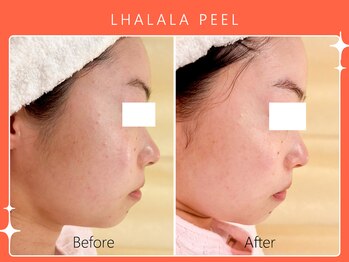 ハノハノ 八代店(HANO HANO)/韓国肌管理ララピール☆