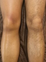 ラピス(Lapis)/足全体ワックス脱毛