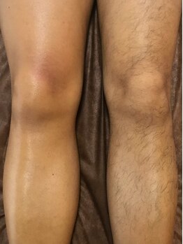 ラピス(Lapis)/足全体ワックス脱毛