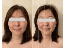 グロッシー(glossy)/小顔矯正