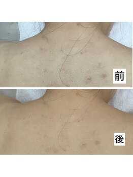 ハズキ(HAZUKI)/背中/ハーブ/美白