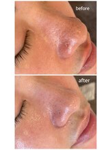 マイルーチェ 可児川合店(MyLuce)/陶肌トリートメント♪施術1回