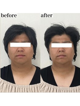 ヴェルシック(Belchic)/脂肪を減らしリフトアップ