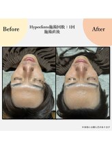 スリール(sourire)/ビフォーアフター